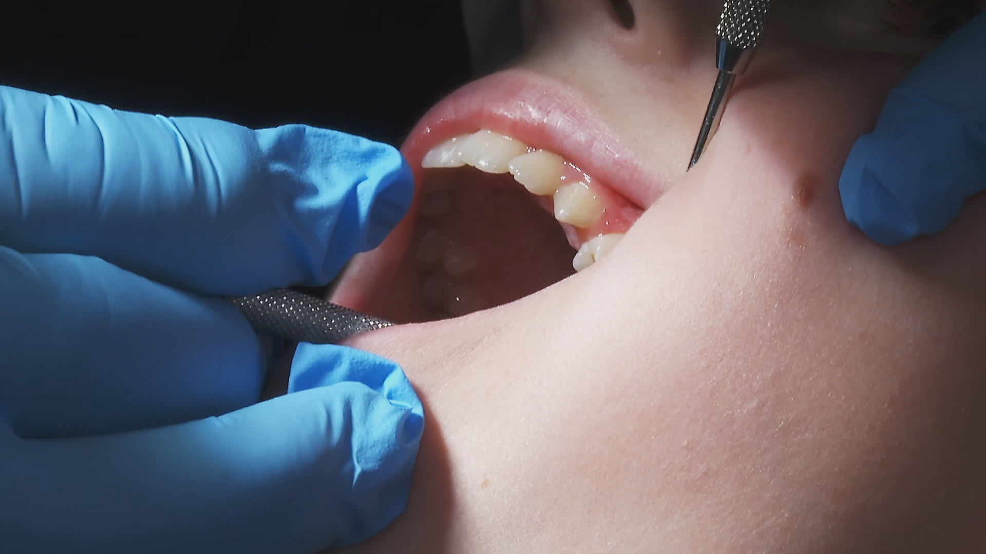 Zubní kazy u dětí? Mohou za to špatné návyky i nedůslední rodiče.