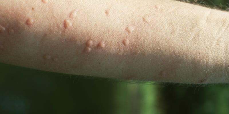 Pokousání ohnivými mravenci může vést až k alergickému šoku.