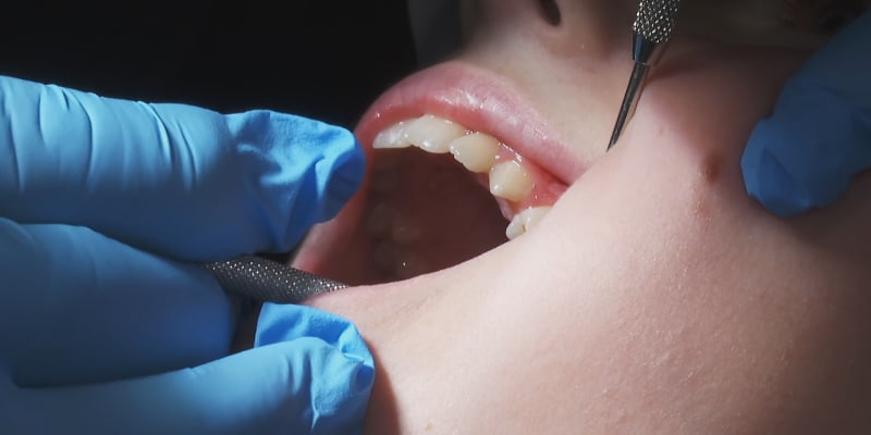 Zubní kazy u dětí? Mohou za to špatné návyky i nedůslední rodiče.