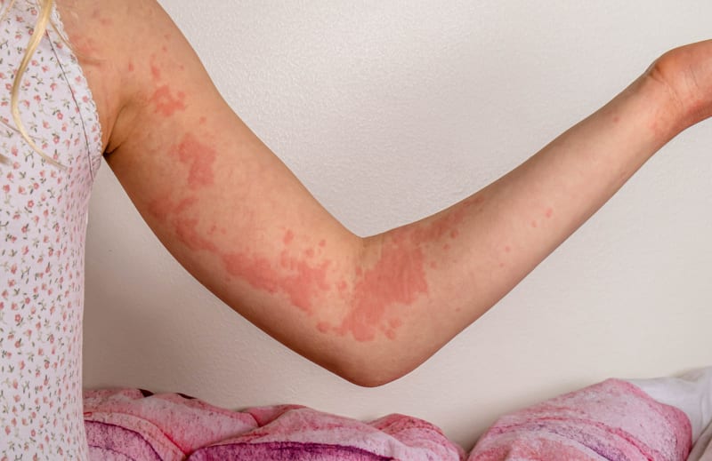 Kopřivka je jedním z hlavních příznaků alergických reakcí