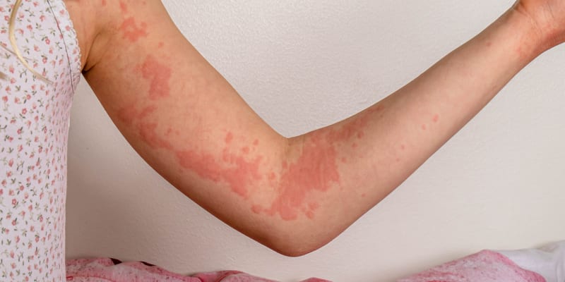 Kopřivka je jedním z hlavních příznaků alergických reakcí
