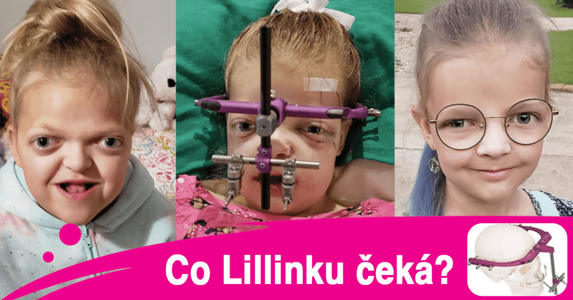 Operace v zahraničí může Lilli změnit život, s následnou léčbou však vyjde na zhruba deset milionů korun. Rodiče tak prosí o pomoc veřejnost. 