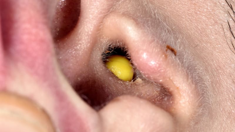 Pavouk v lidském uchu: Lékaři natočili noční můru arachnofobů