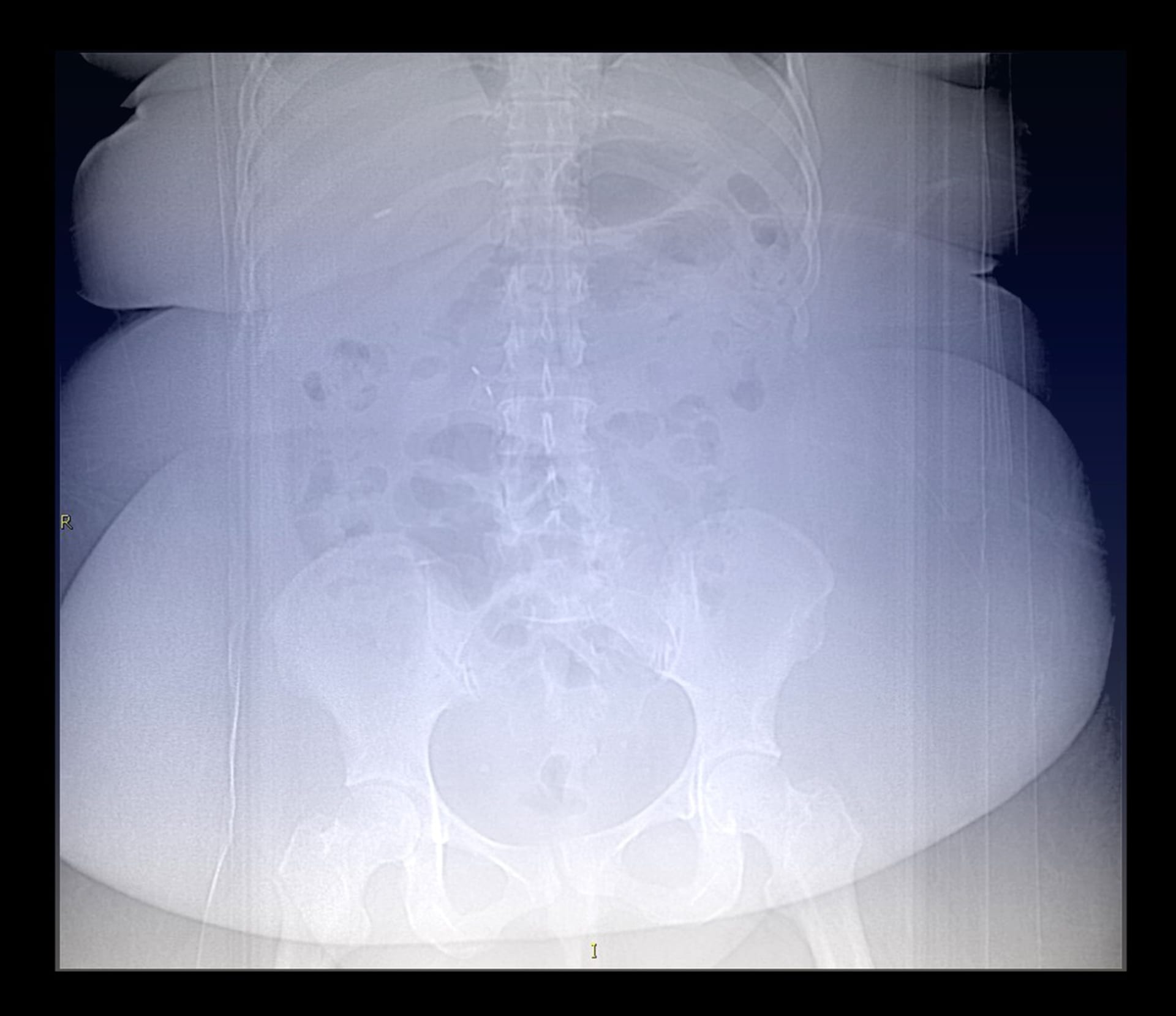 Obézní člověk na rentgenu