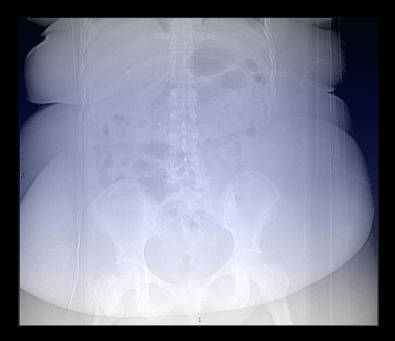 Obézní člověk na rentgenu