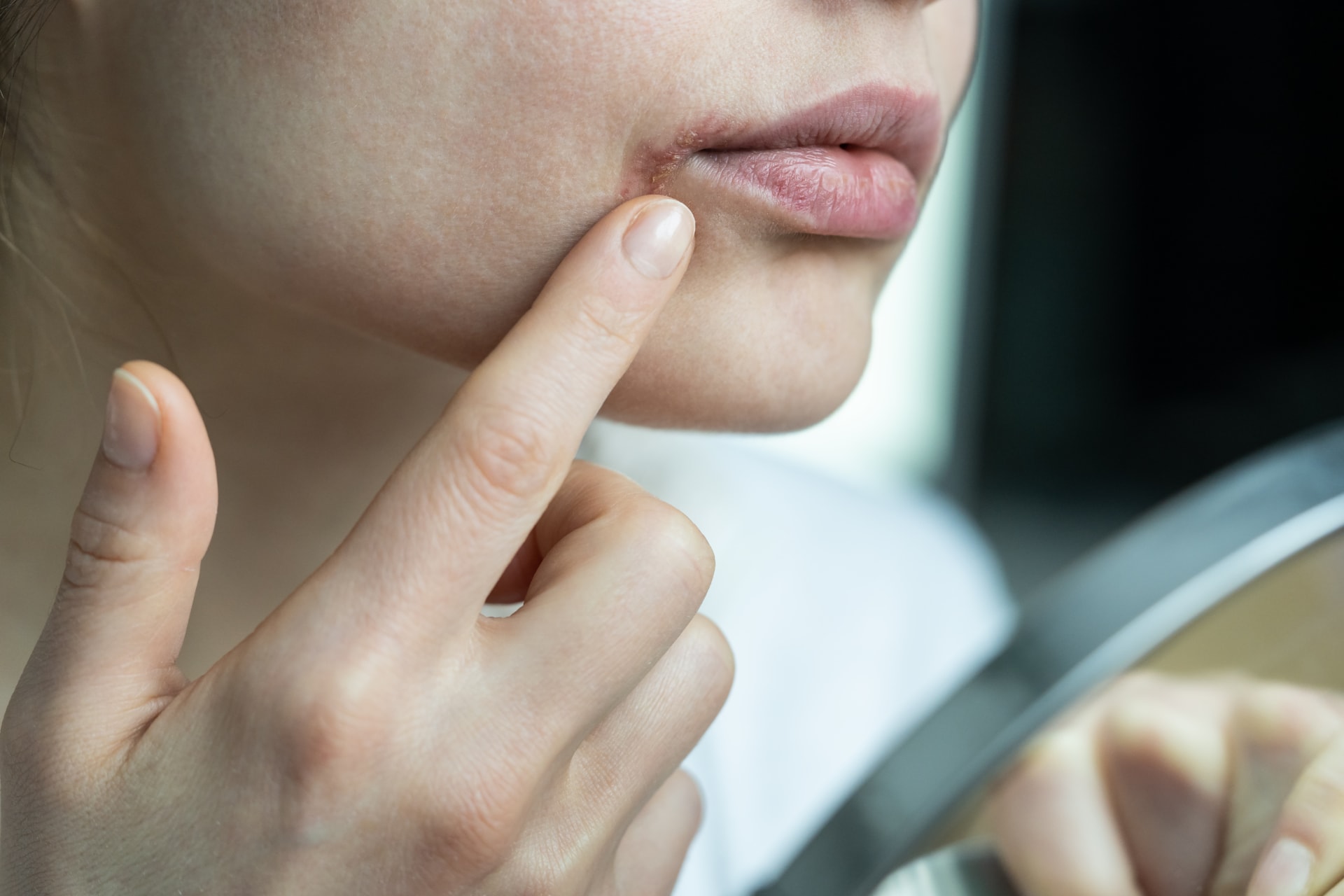Popraskané koutky úst mohou značit infekci či zánět v těle. 