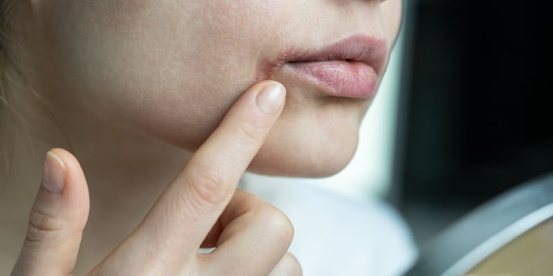 Popraskané koutky úst mohou značit infekci či zánět v těle. 