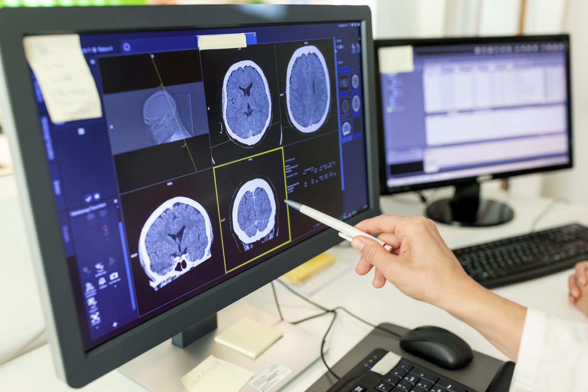 Počítačová tomografie umožňuje zobrazit různé části mozku pomocí rentgenového záření a následné počítačové rekonstrukce (ilustrační foto).