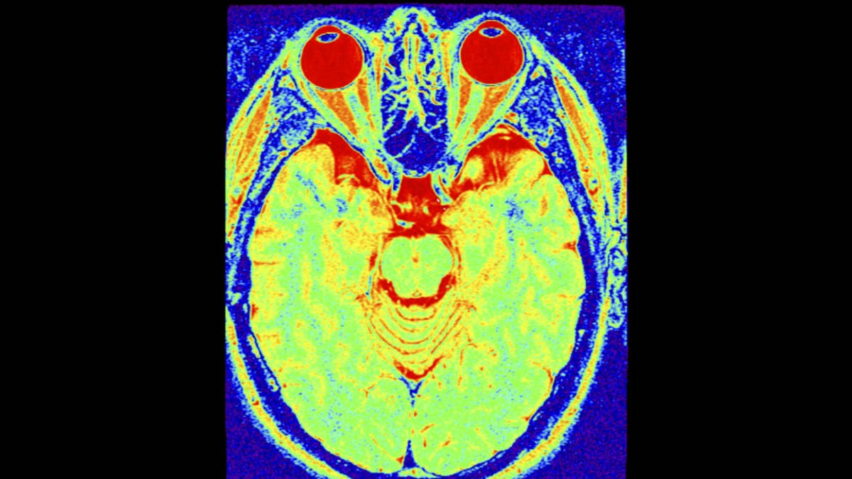 Magnetická rezonance mozku