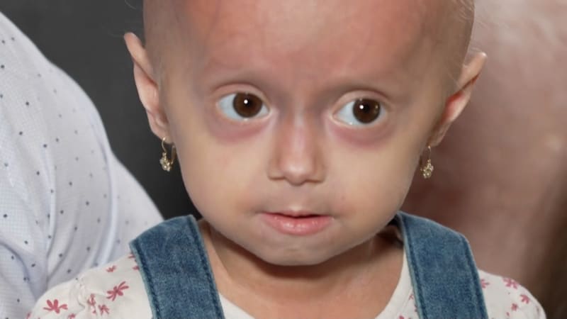 Adélka trpí vzácnou genetickou poruchou zvanou progerie. Zřejmě je jediná v Česku.