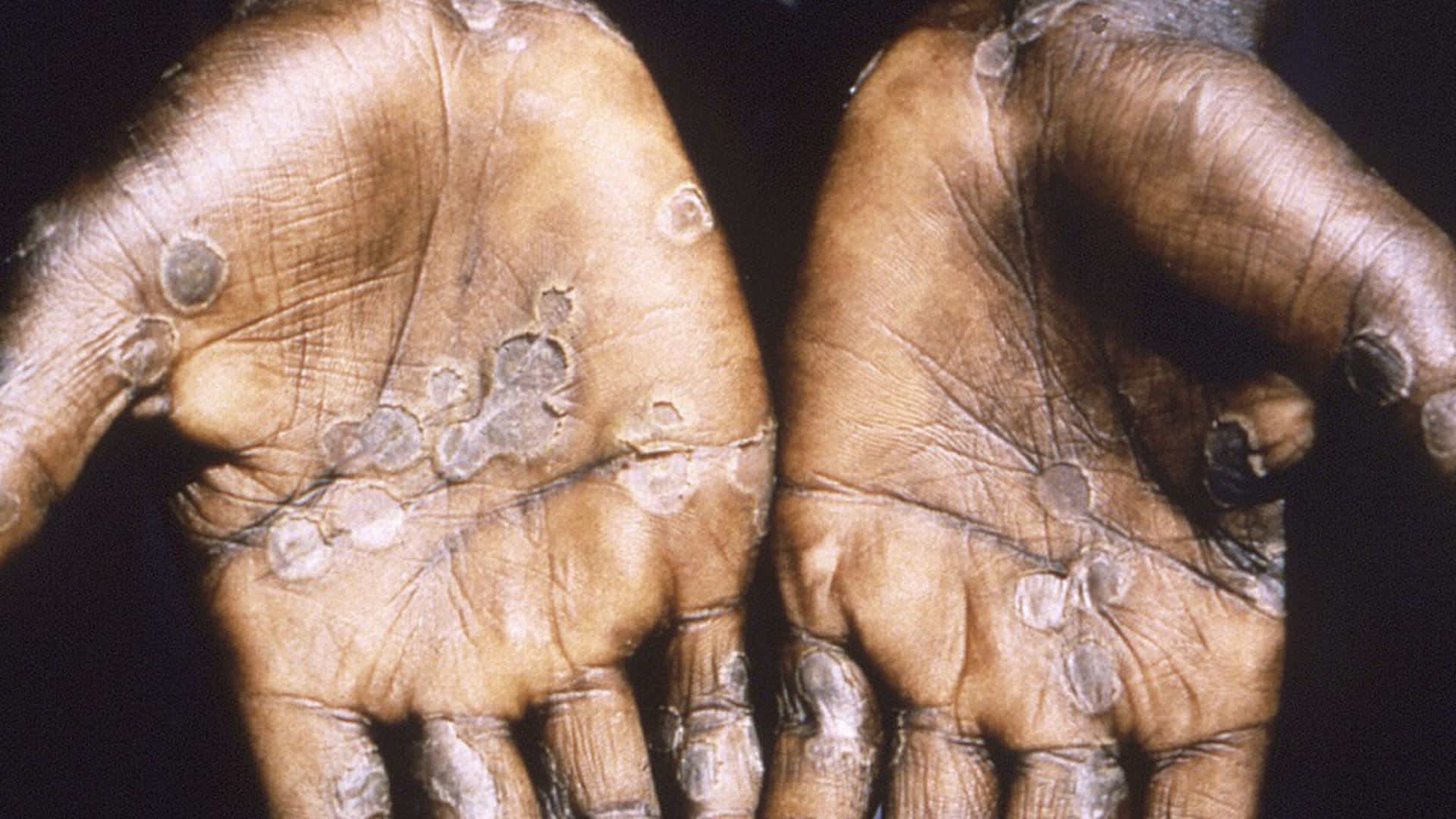 Následky mpox, opičích neštovic