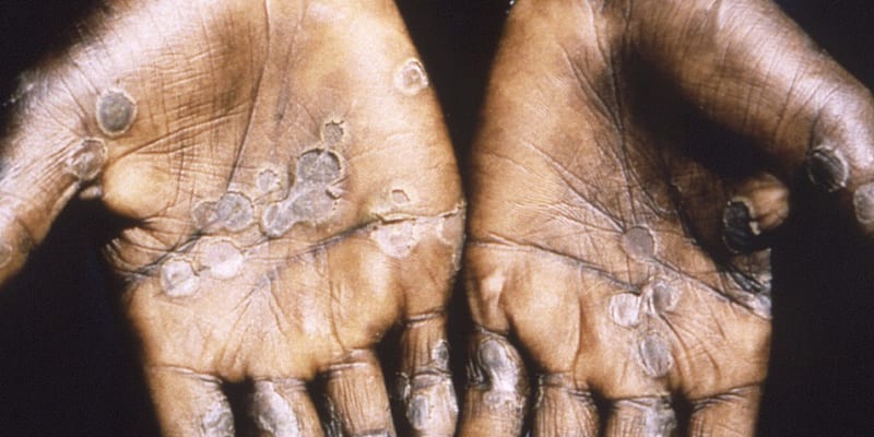 Následky mpox, opičích neštovic